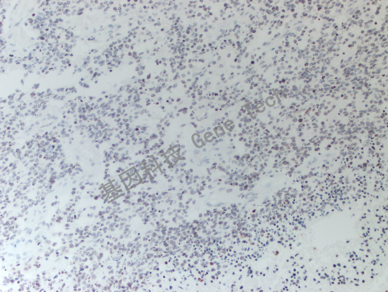 20200513-16 H3K36M 24-T BI5-3胶质瘤_副本.jpg