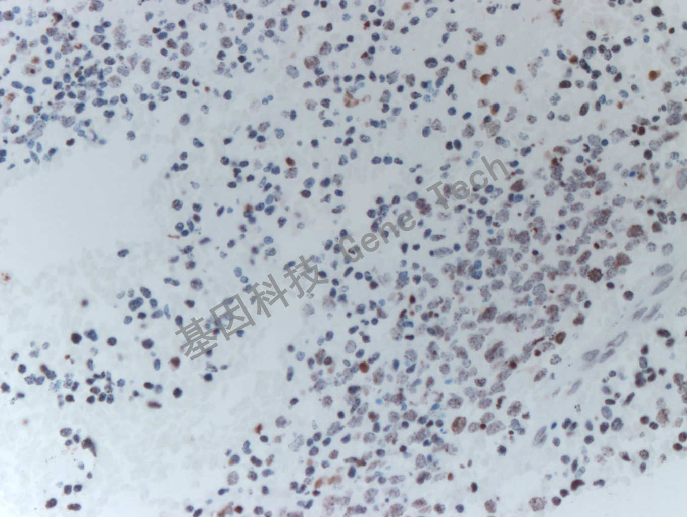 20200513-16 H3K36M 24-T BI5-7胶质瘤_副本.jpg