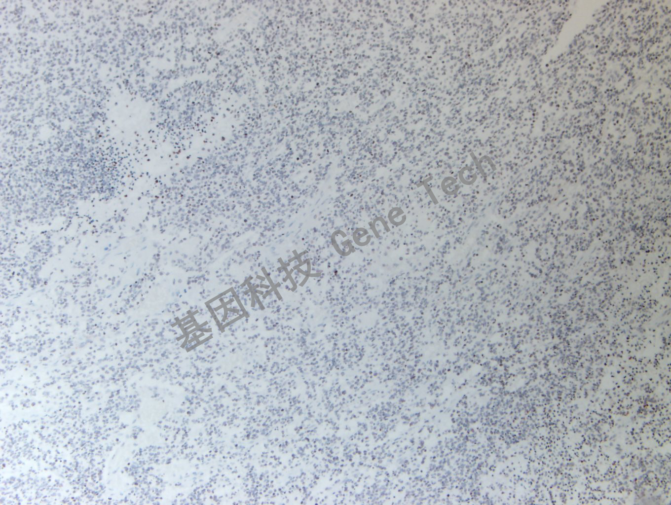 20200513-16 H3K36M 24-T BI5胶质瘤_副本.jpg