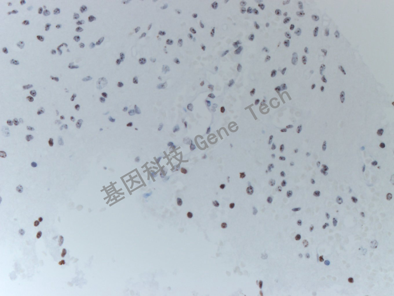 20200513-16 H3K36M 24-T BI6-2胶质瘤_副本.jpg