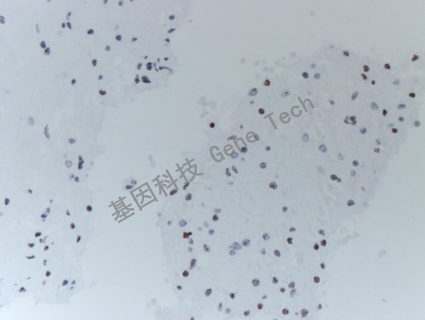 20200513-16 H3K36M 24-T BI6-3胶质瘤_副本.jpg