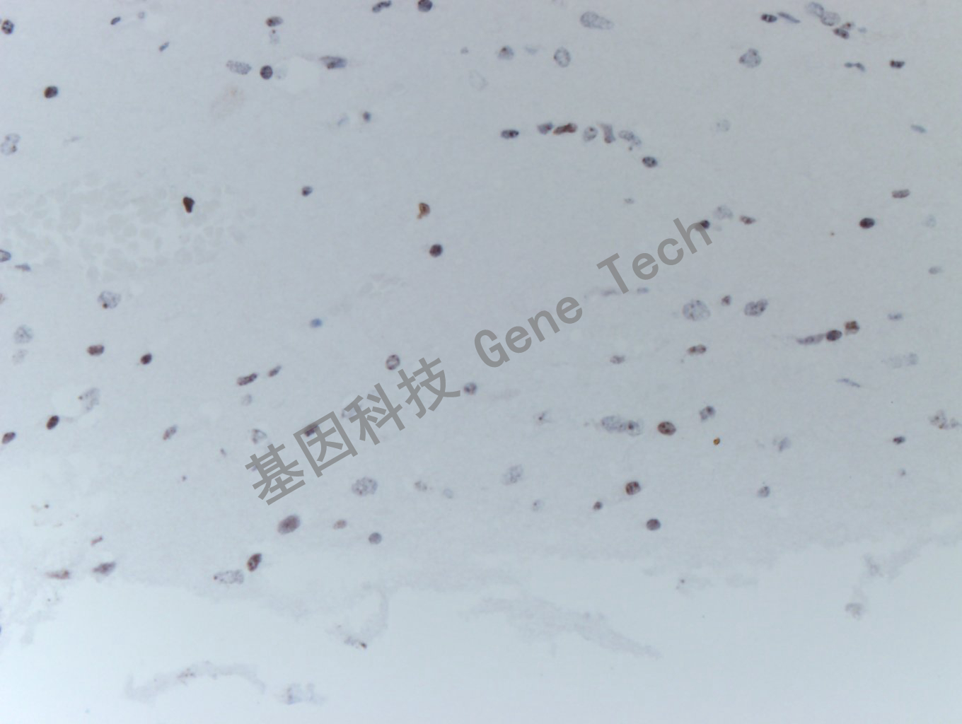 20200513-16 H3K36M 24-T BI6-4胶质瘤_副本.jpg