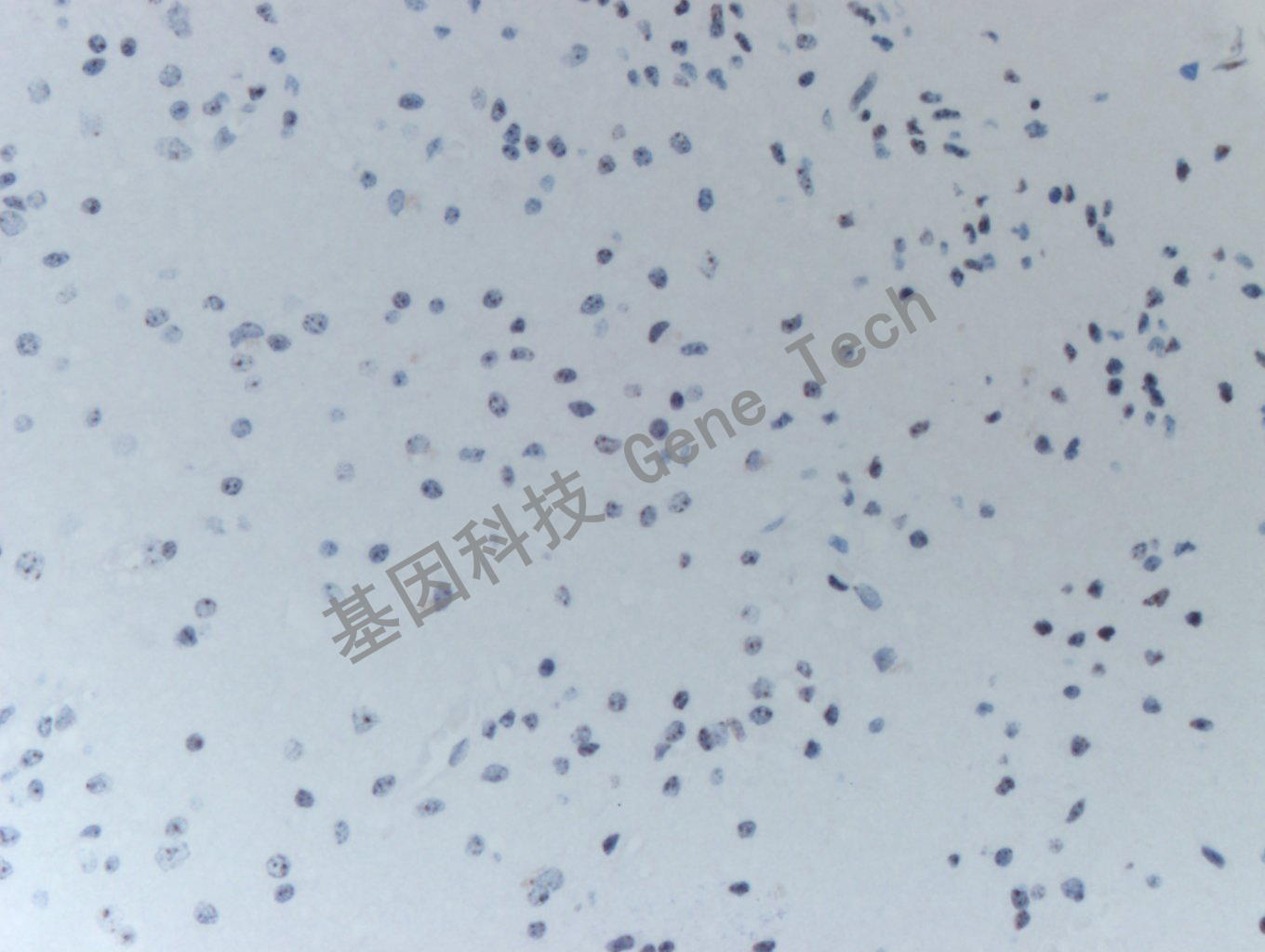 20200513-16 H3K36M 24-T BI6-5胶质瘤_副本.jpg