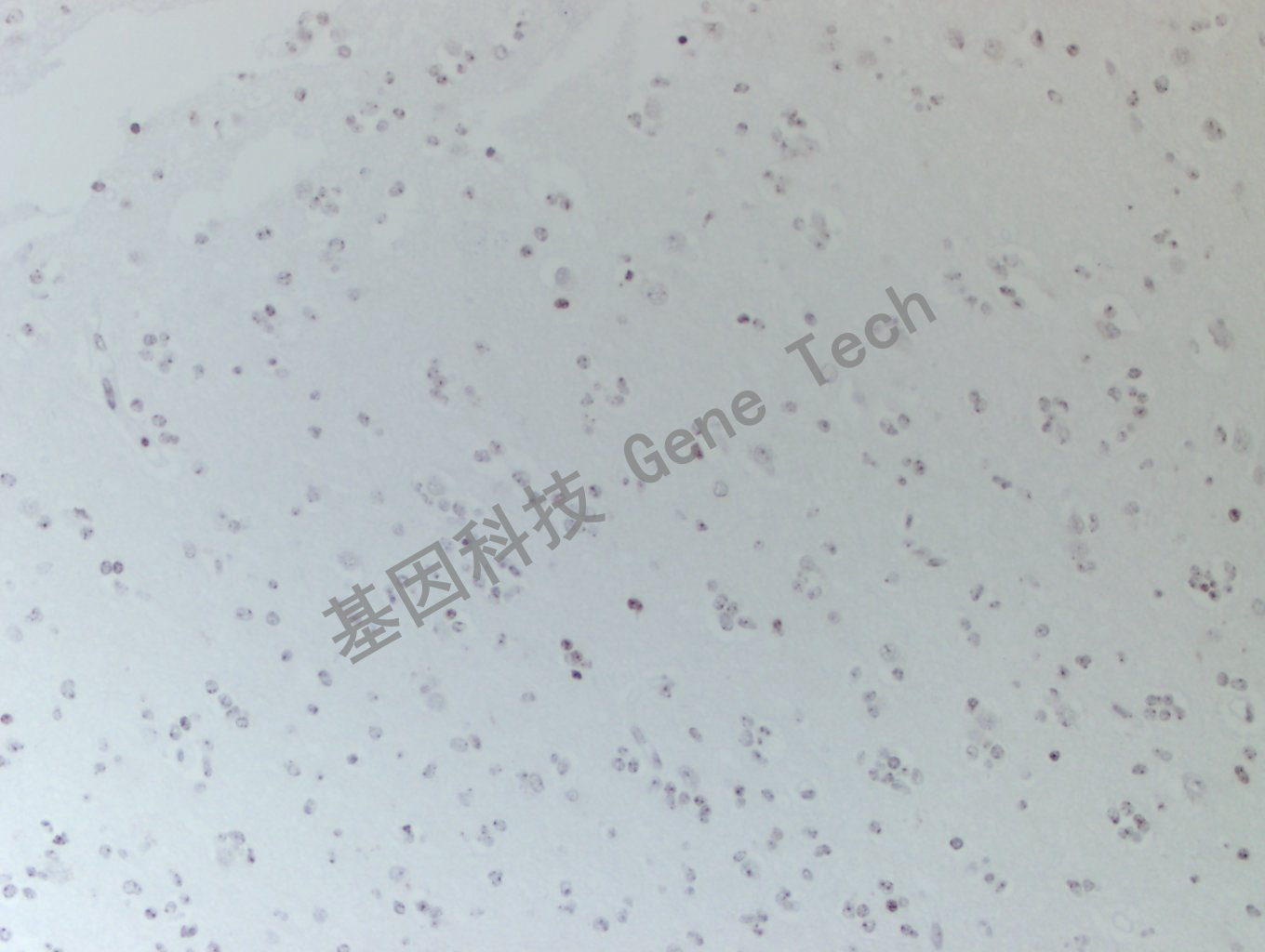 20200513-16 H3K36M 24-T BI11-3胶质瘤_副本.jpg