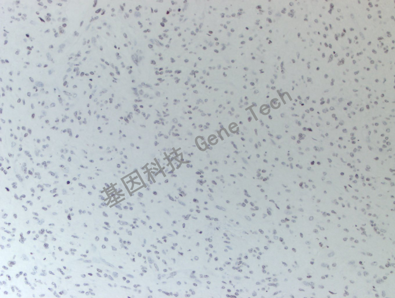 20200513-16 H3K36M 24-T BI12-2胶质瘤_副本.jpg