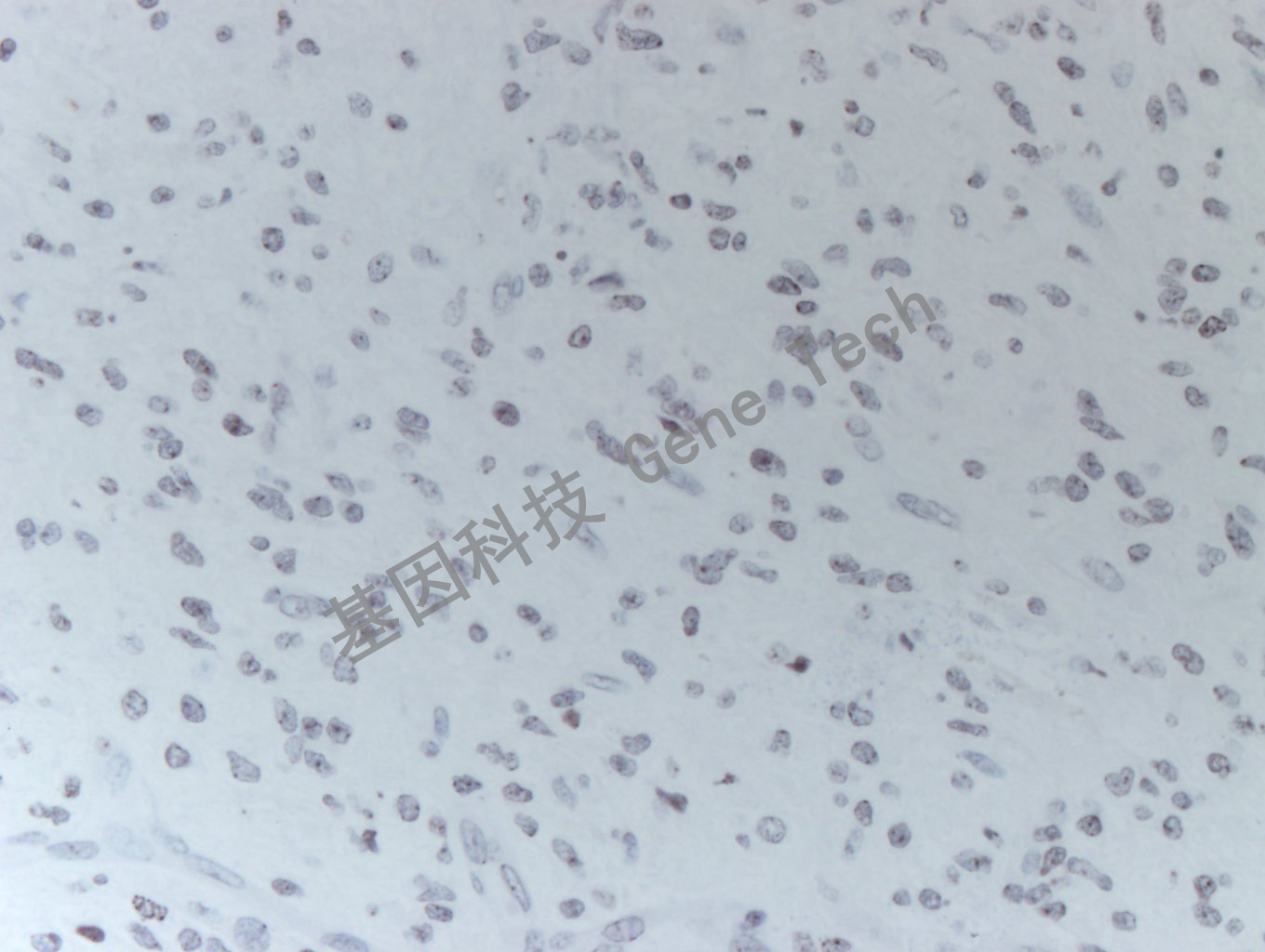 20200513-16 H3K36M 24-T BI12-3胶质瘤_副本.jpg