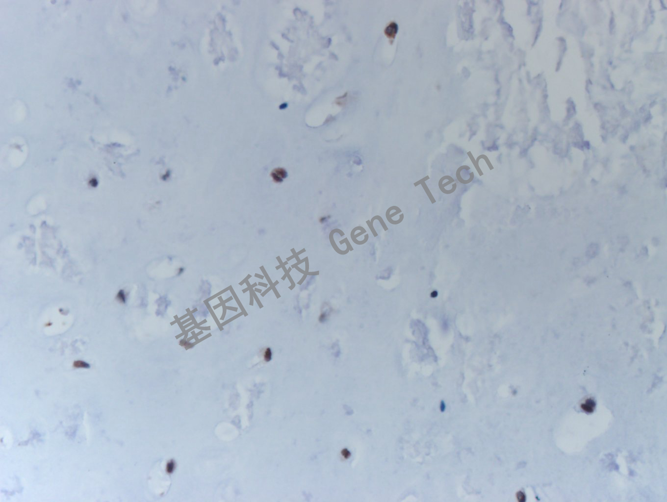 20200513-17 H3K36M CA1 软骨肉瘤-4_副本.jpg