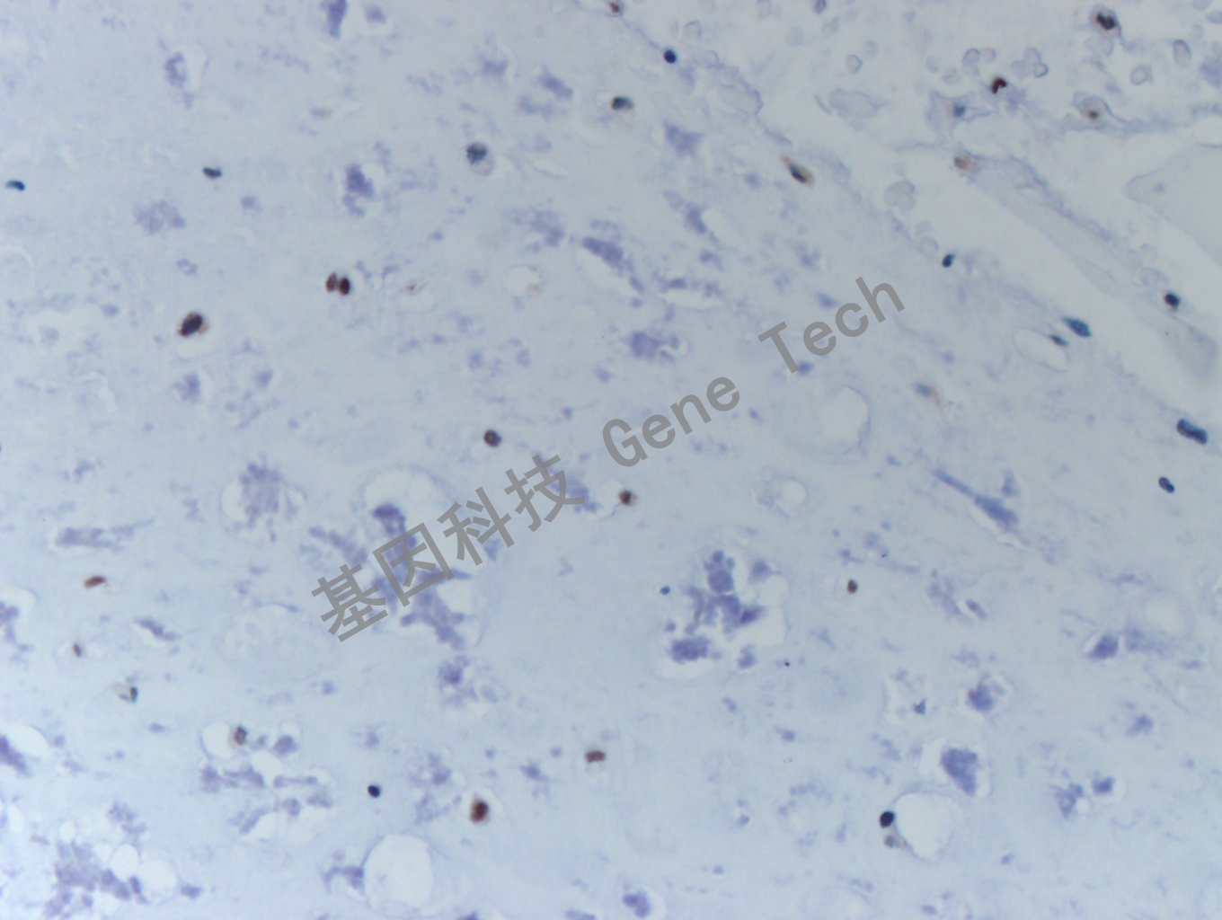 20200513-17 H3K36M CA1 软骨肉瘤-5_副本.jpg