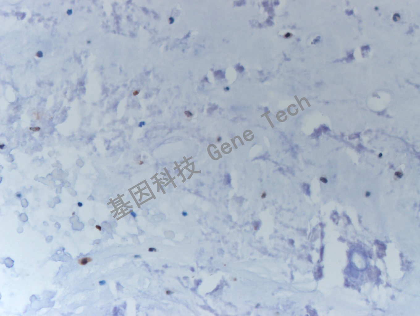 20200513-17 H3K36M CA1 软骨肉瘤-8_副本.jpg