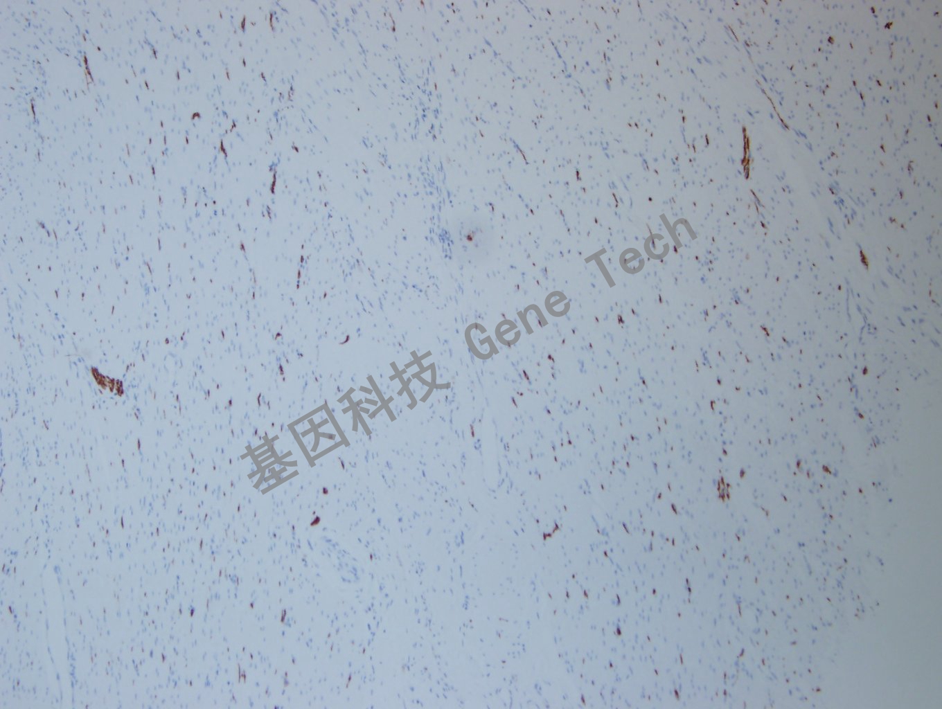 1668483591212180.jpg 20200922-13 L1CAM E24 胃癌-3_副本.jpg