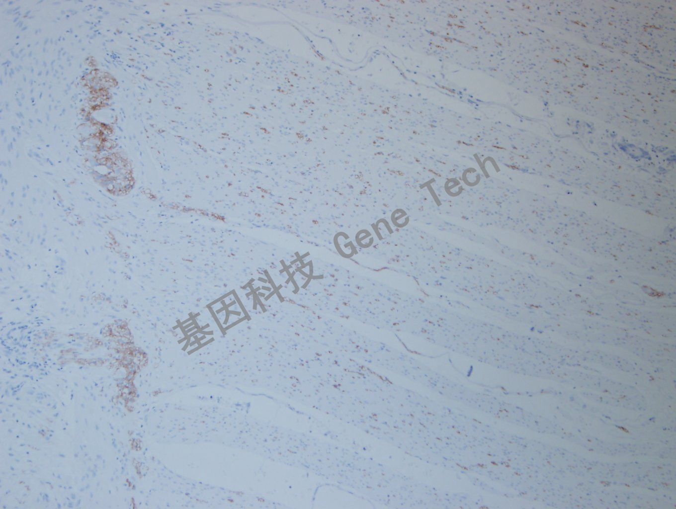 1668483601916033.jpg 20200922-12 L1CAM F47 结肠癌-3_副本.jpg