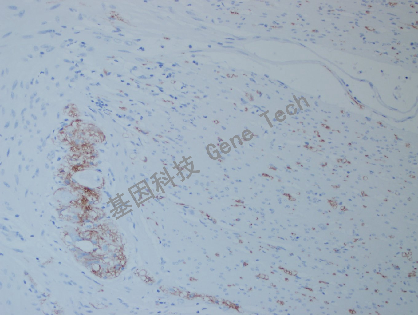 1668483607142779.jpg 20200922-12 L1CAM F47 结肠癌-4_副本.jpg