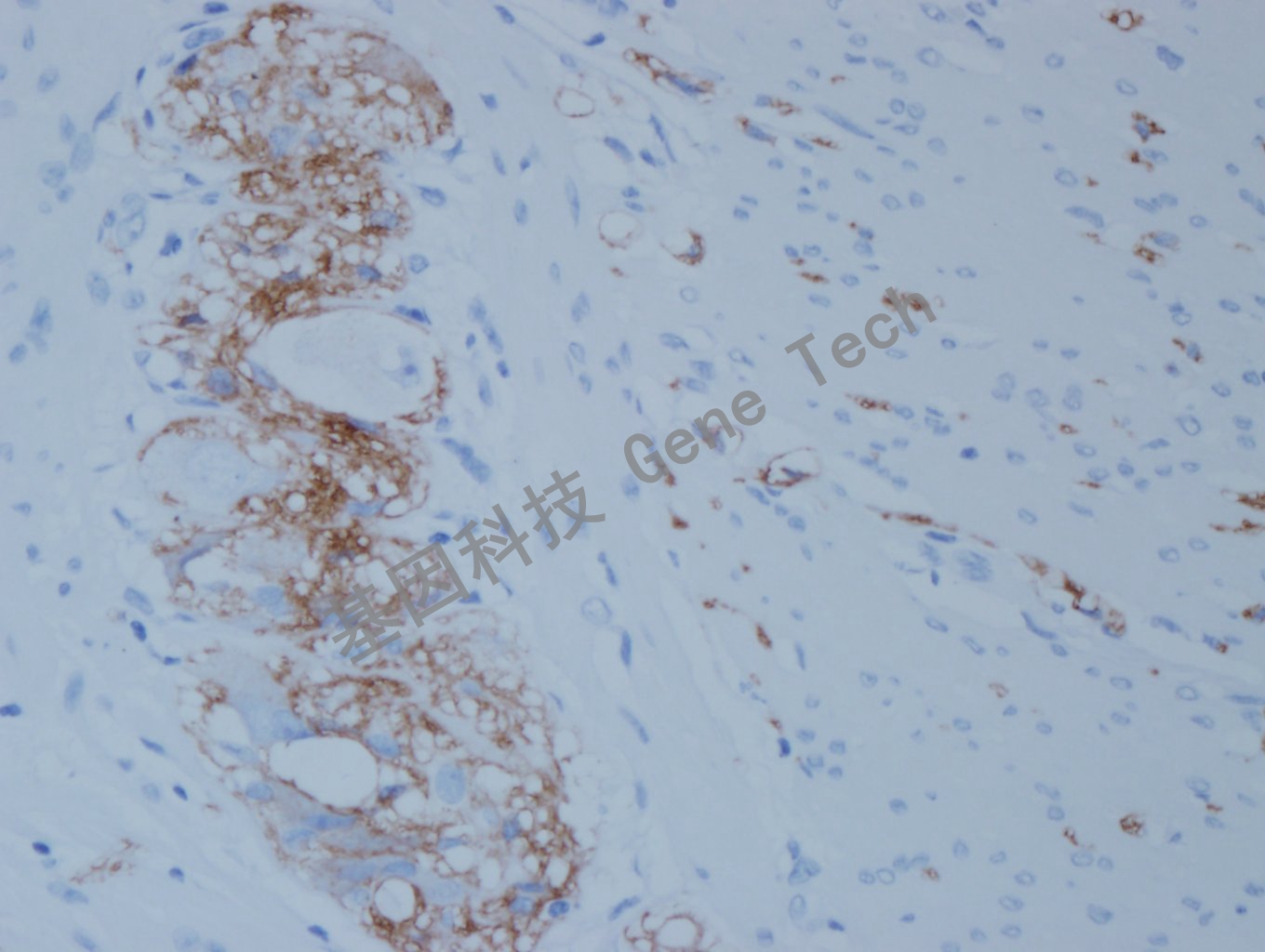 1668483615166158.jpg 20200922-12 L1CAM F47 结肠癌-5_副本.jpg