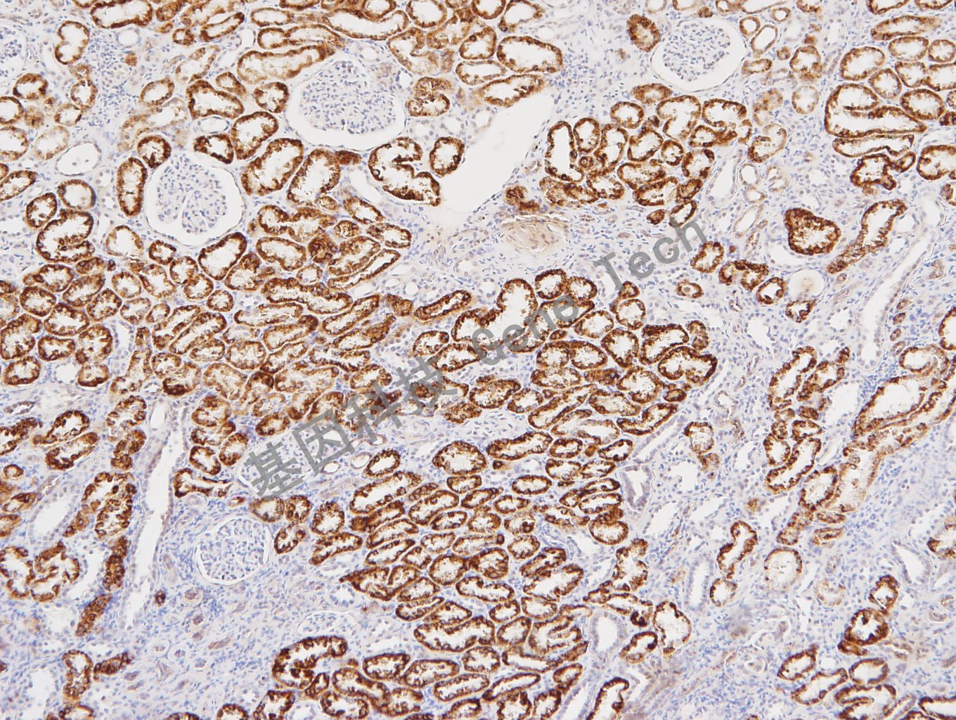 1681796053197353.jpg 20171207-15 肾癌 1:2000_副本.jpg