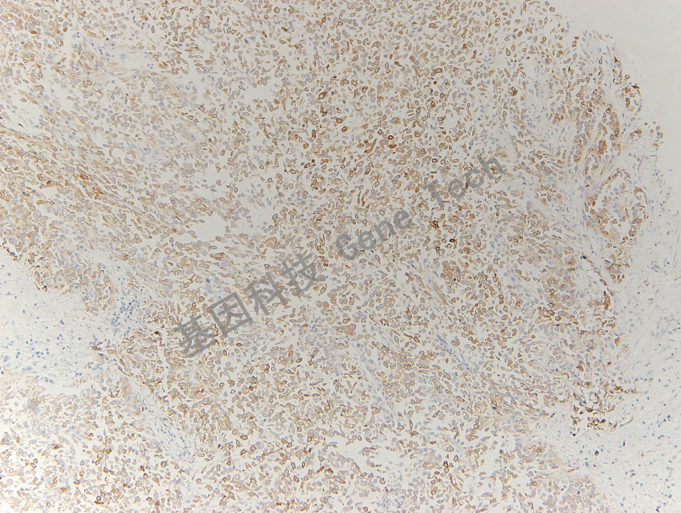 20200330-15 Uroplakin2 L2 膀胱癌-2_副本.jpg