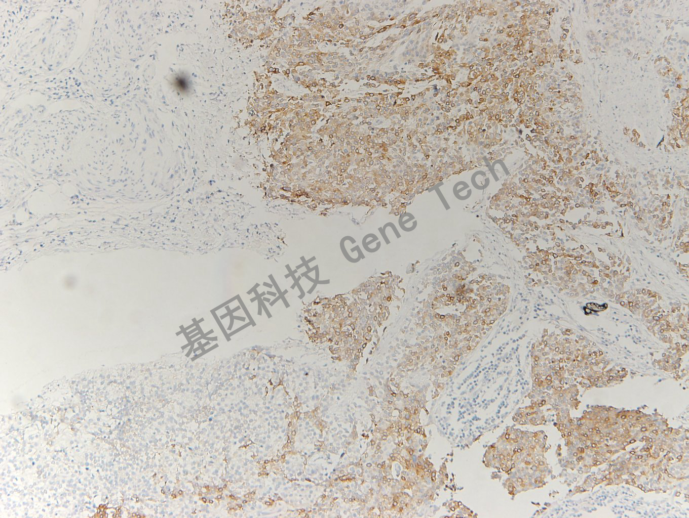 20200330-15 Uroplakin2 L2 膀胱癌-3_副本.jpg