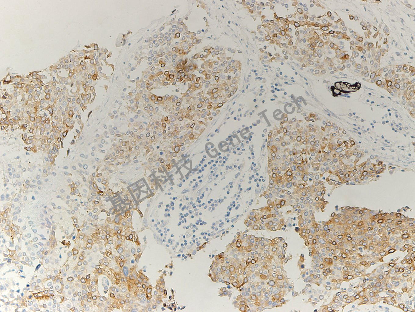 20200330-15 Uroplakin2 L2 膀胱癌-4_副本.jpg