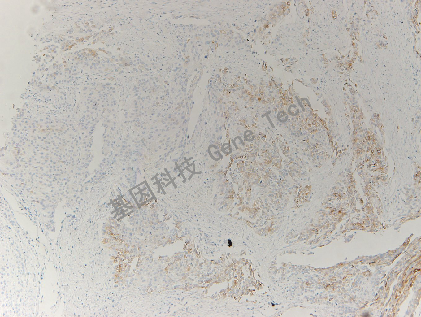 20200330-15 Uroplakin2 L2 膀胱癌-5_副本.jpg