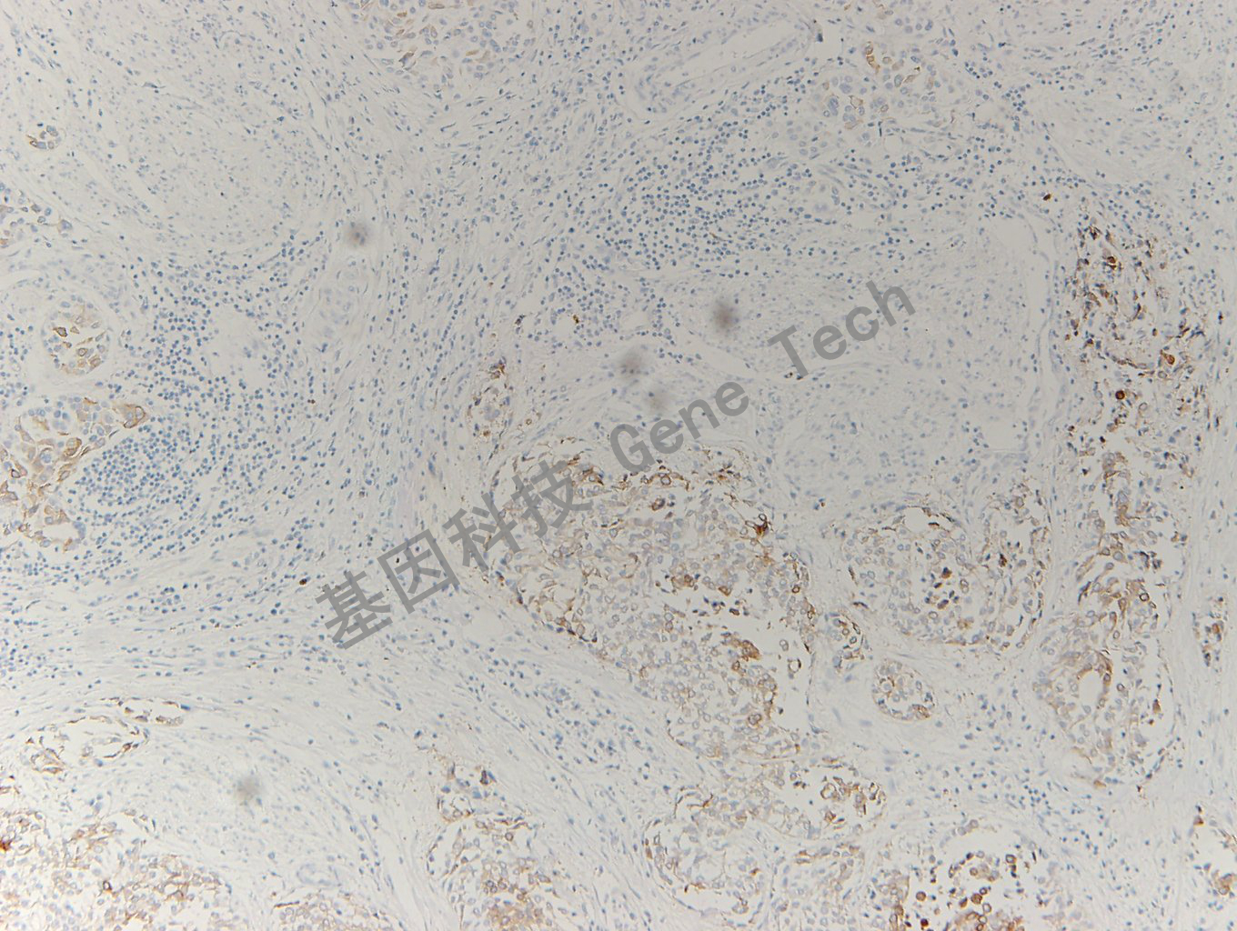 20200330-15 Uroplakin2 L2 膀胱癌-6_副本.jpg
