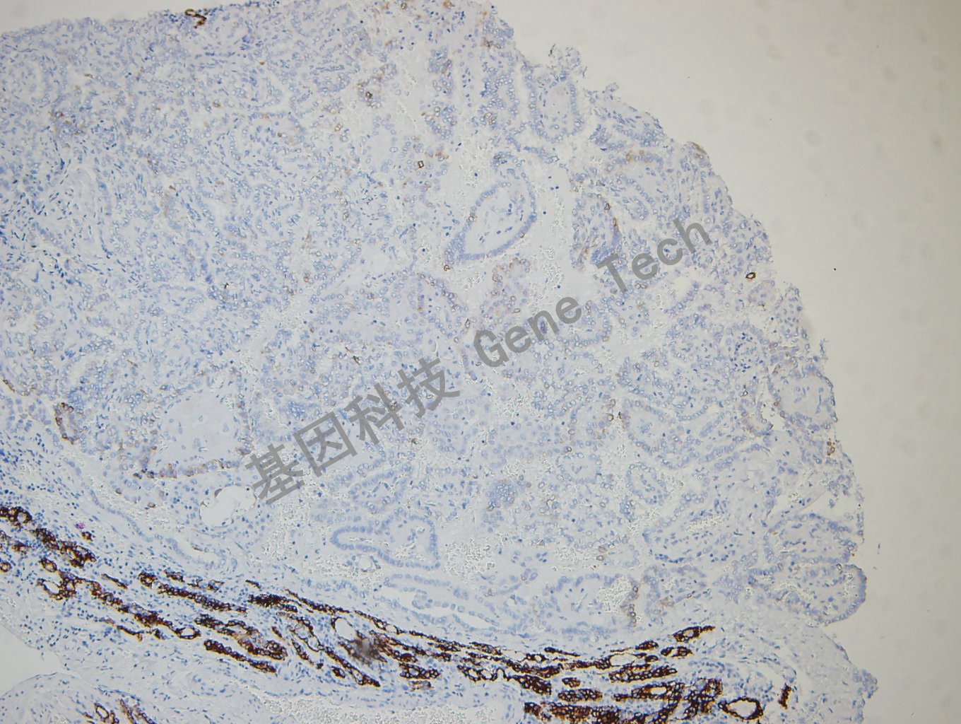 20180730-6 06-T5 甲状腺癌1-2_副本.jpg