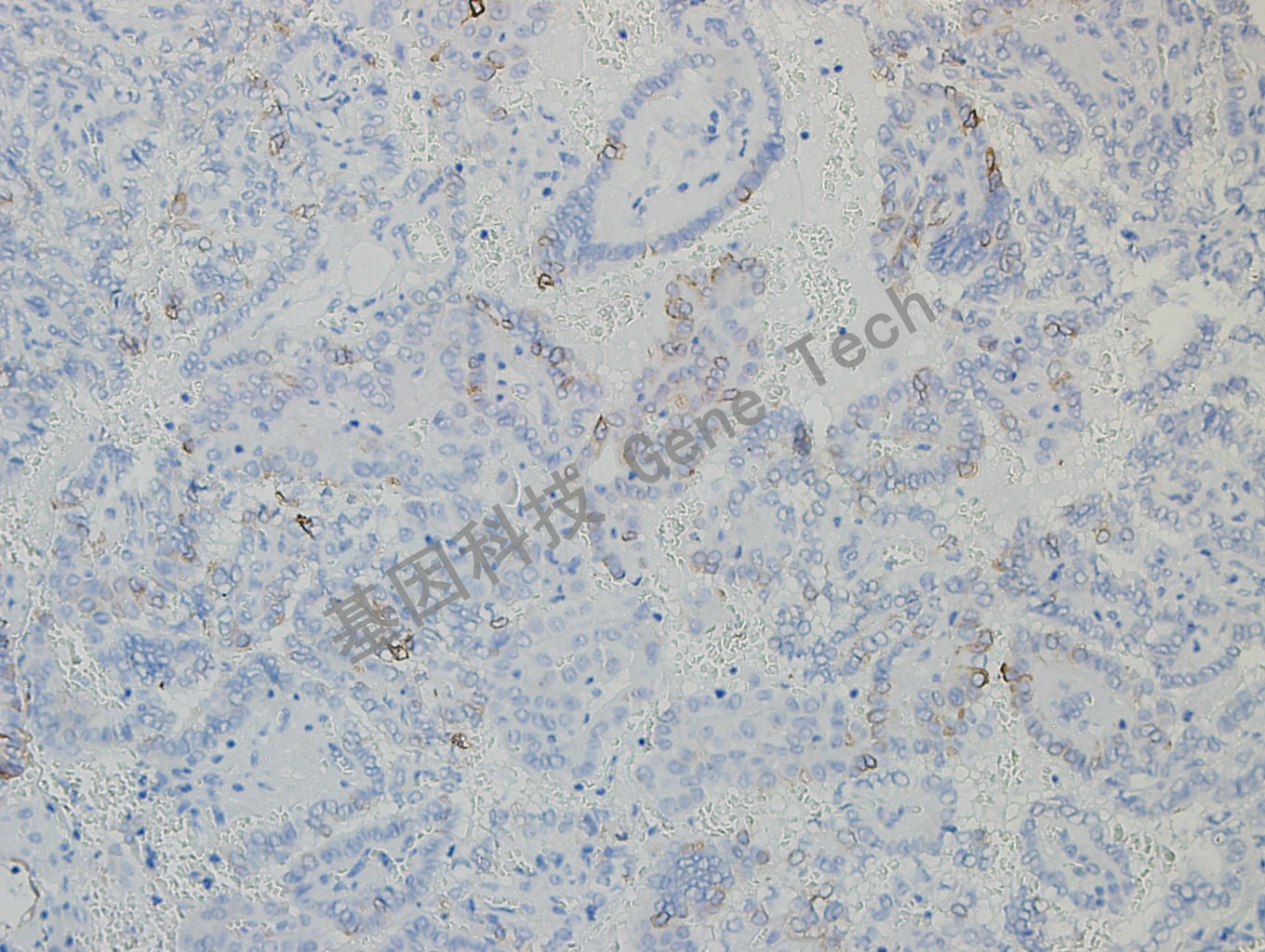 20180730-6 06-T5 甲状腺癌1-3_副本.jpg