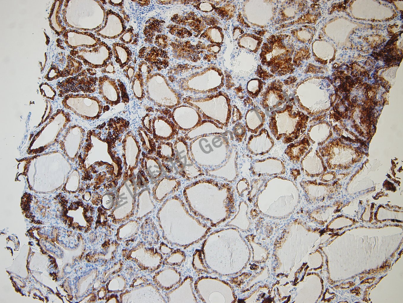 20180730-6 06-T5 甲状腺瘤_副本.jpg