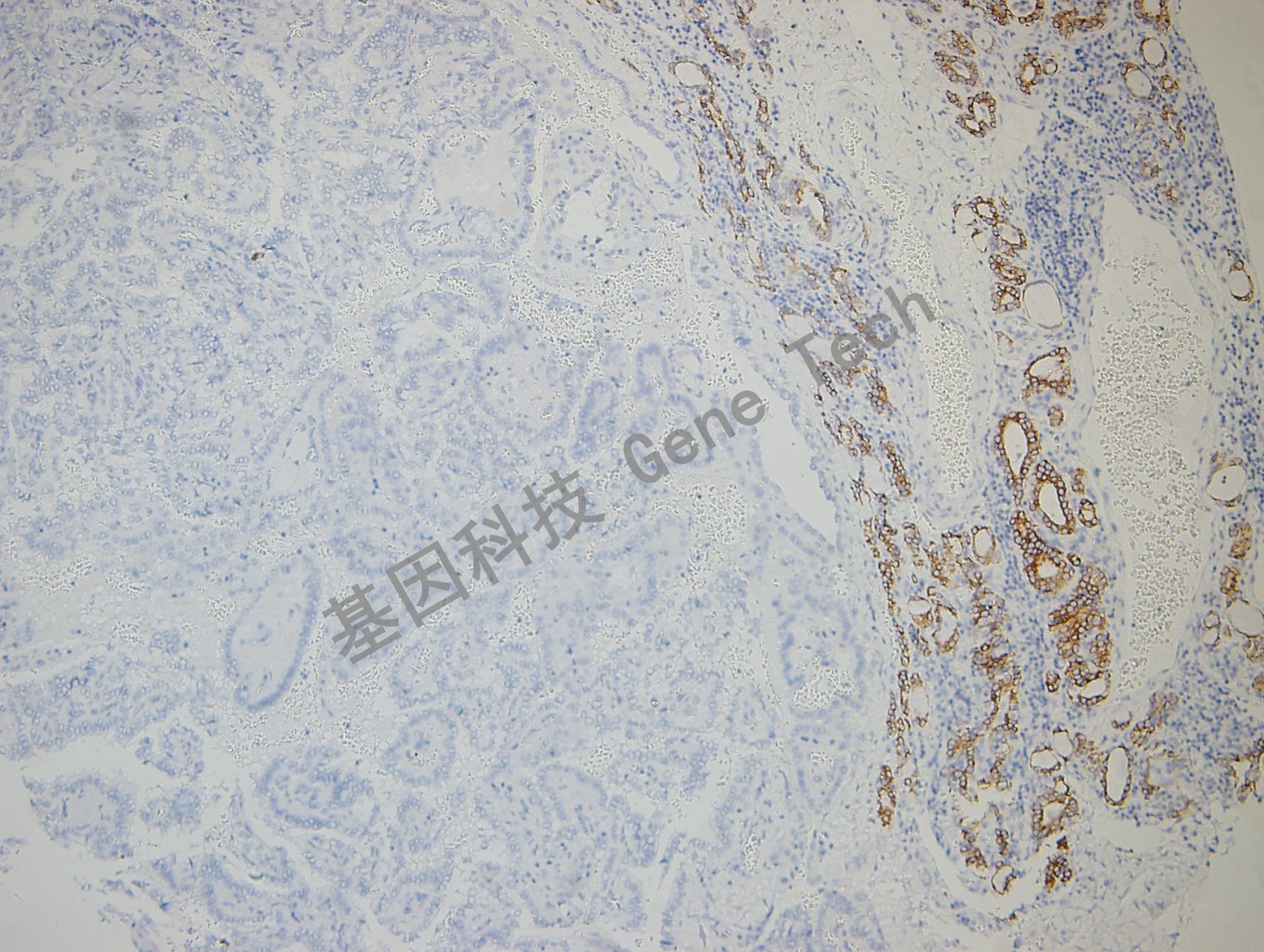 20180730-7 06-T5 甲状腺癌1-1_副本.jpg