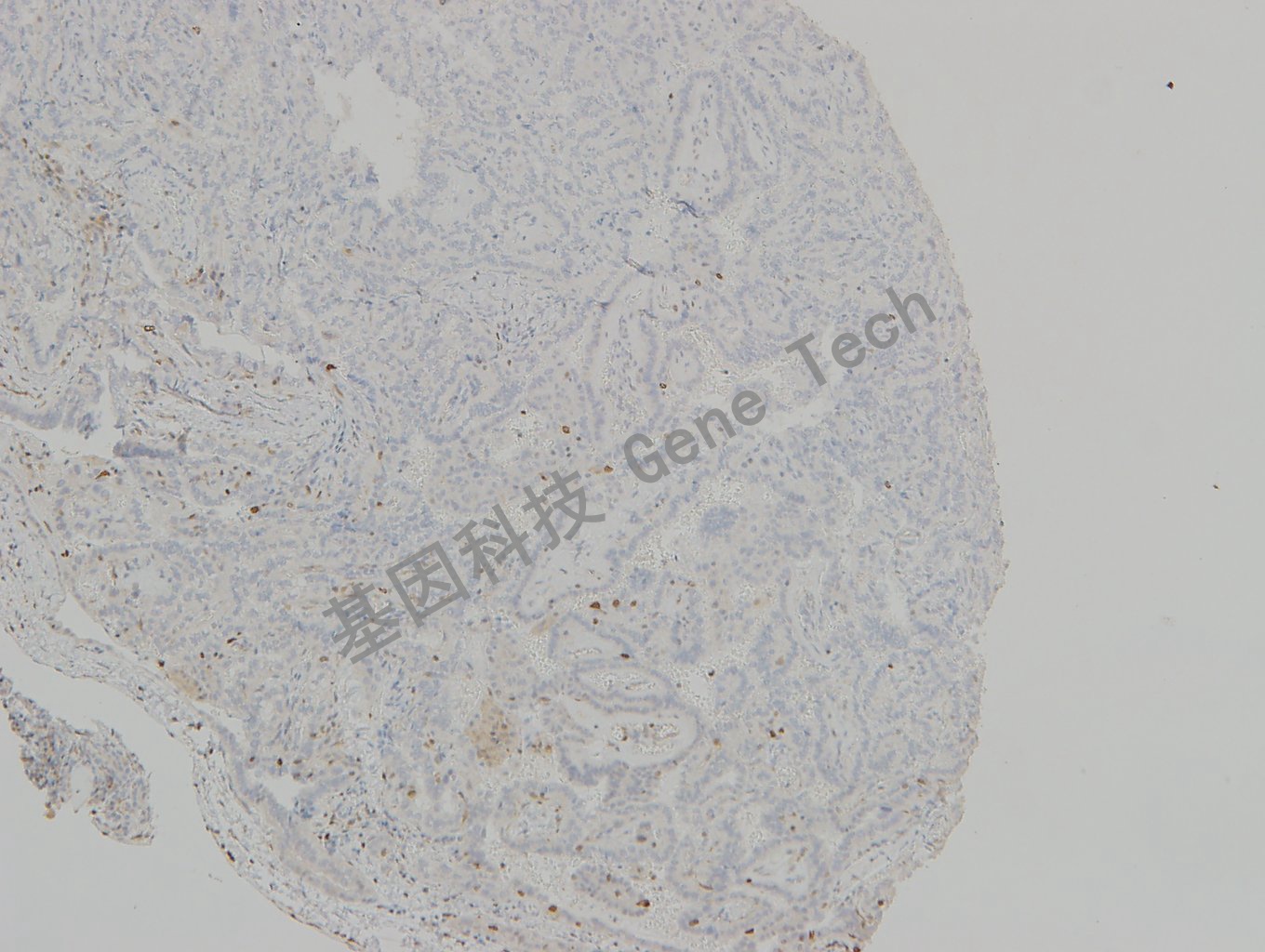 20190315-22 TOPIIa 06-T5 甲状腺滤泡瘤_副本.jpg