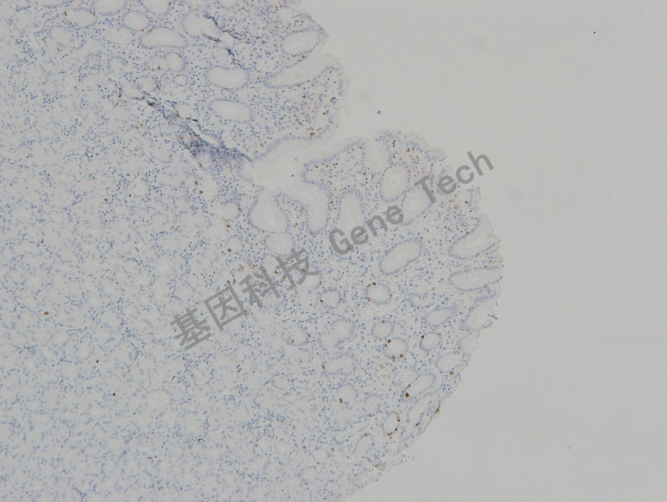 20190315-22 TOPIIa 06-T5 胃癌1_副本.jpg
