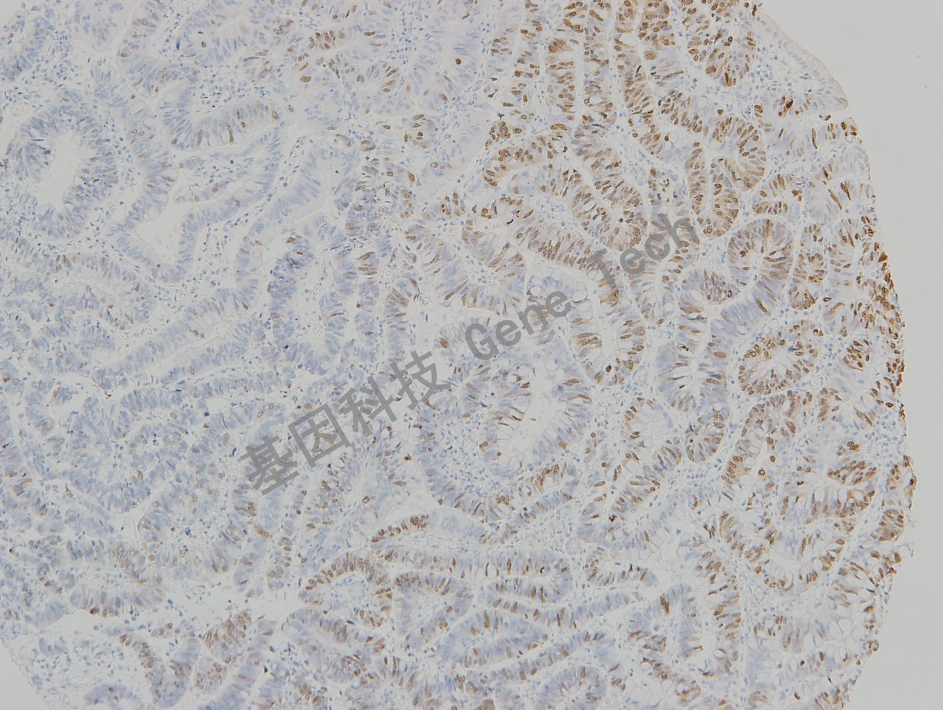 20190315-22 TOPIIa 06-T5 胃癌2-1_副本.jpg