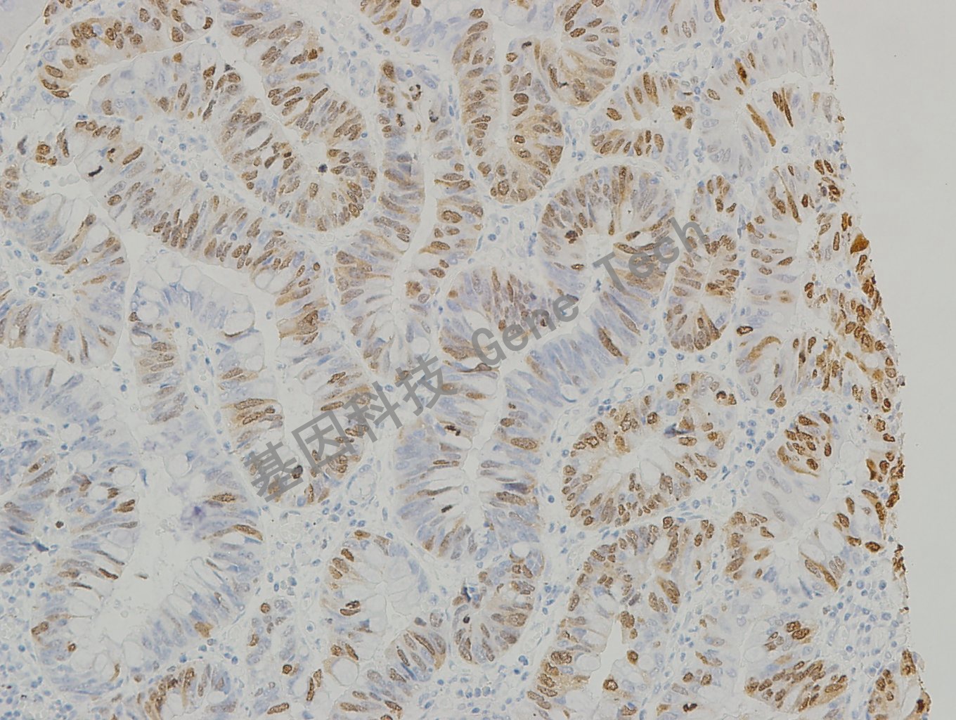 20190315-22 TOPIIa 06-T5 胃癌2-2_副本.jpg