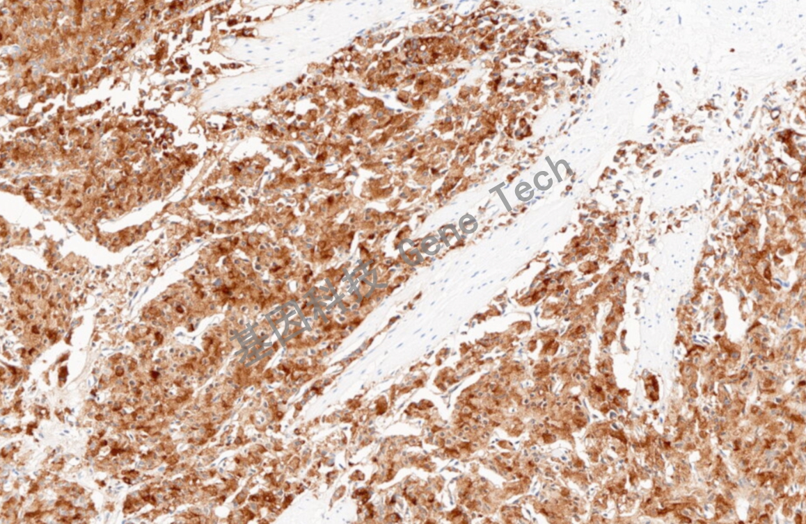 Survivin 10倍 细胞膜+细胞浆 肝癌_副本.jpg