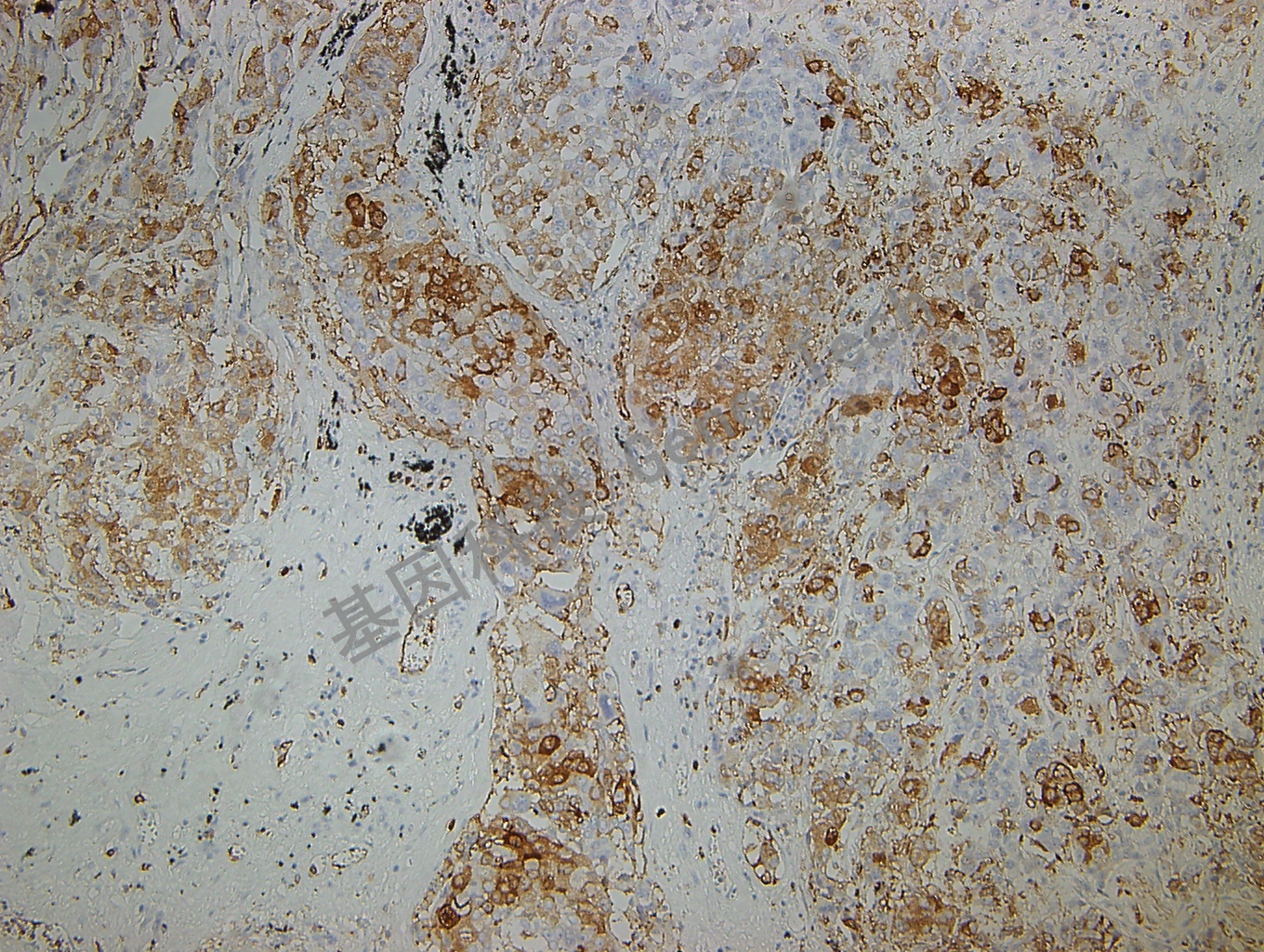 Stathmin GT2215 肺鳞癌_副本.jpg