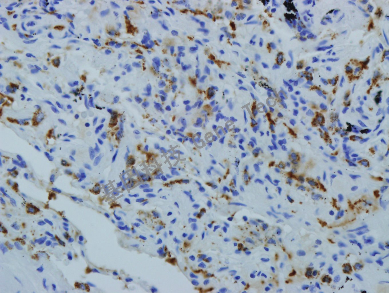 SP-B GT2270 40X 肺癌_副本.jpg