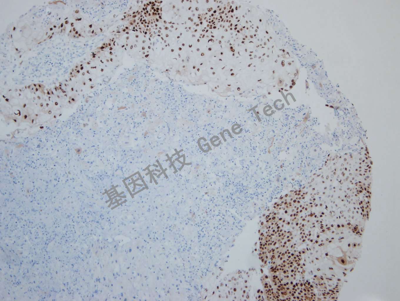 20190927-14 SOX9 06-T5 食管癌2_副本.jpg