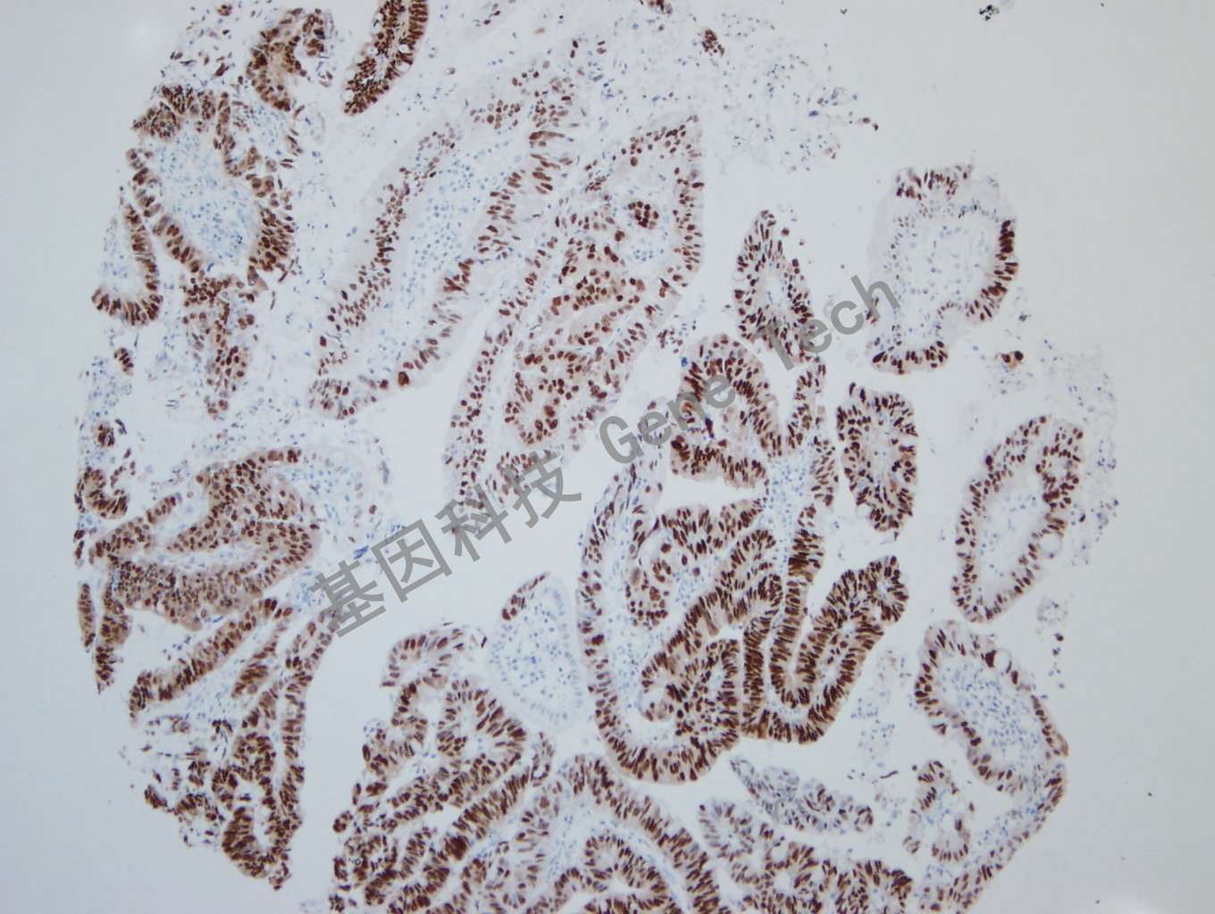 20190927-14 SOX9 06-T5 胃癌2_副本.jpg