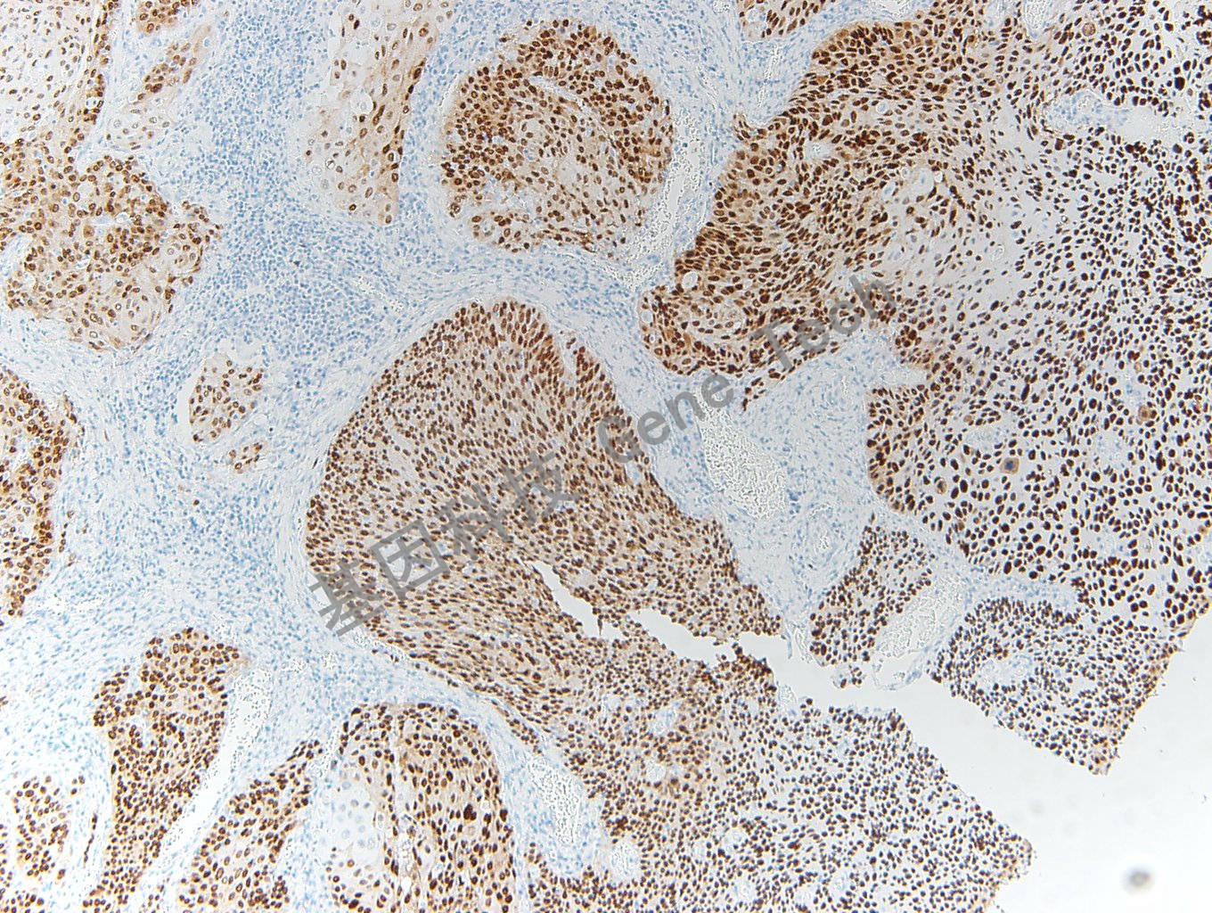 20200416-20 SOX-2 O6 宫颈癌-2_副本.jpg