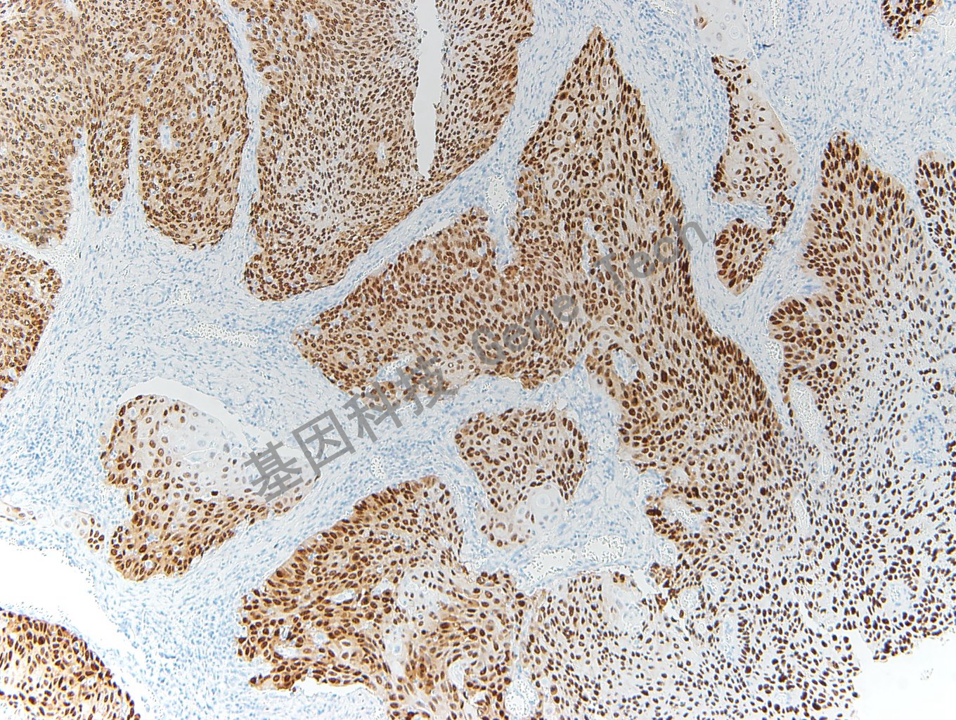 20200416-20 SOX-2 O6 宫颈癌-3_副本.jpg