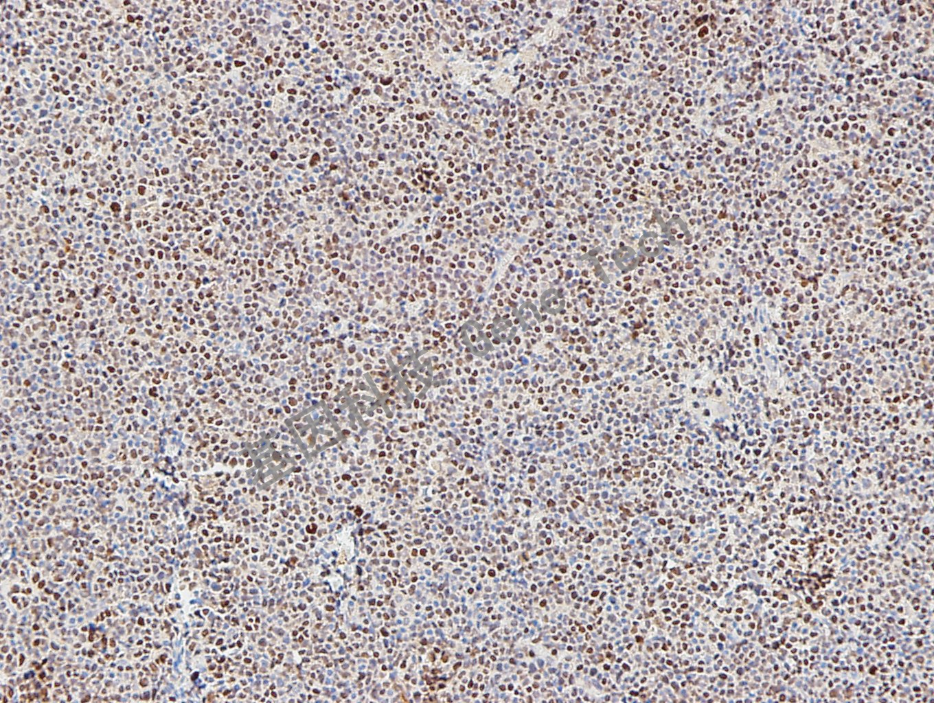 SOX-11 套细胞淋巴瘤_副本.jpg