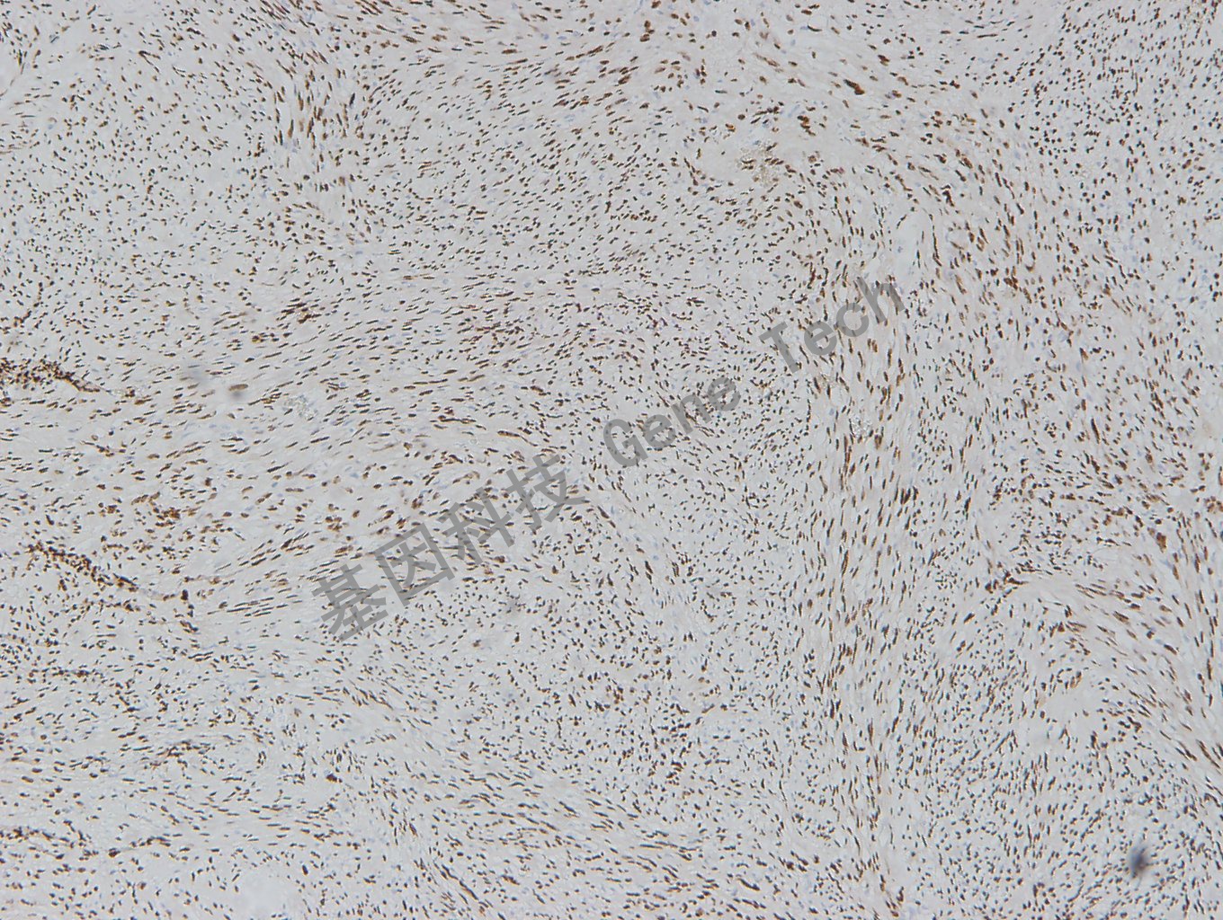 20180517-20 T2 神经鞘瘤-2_副本.jpg