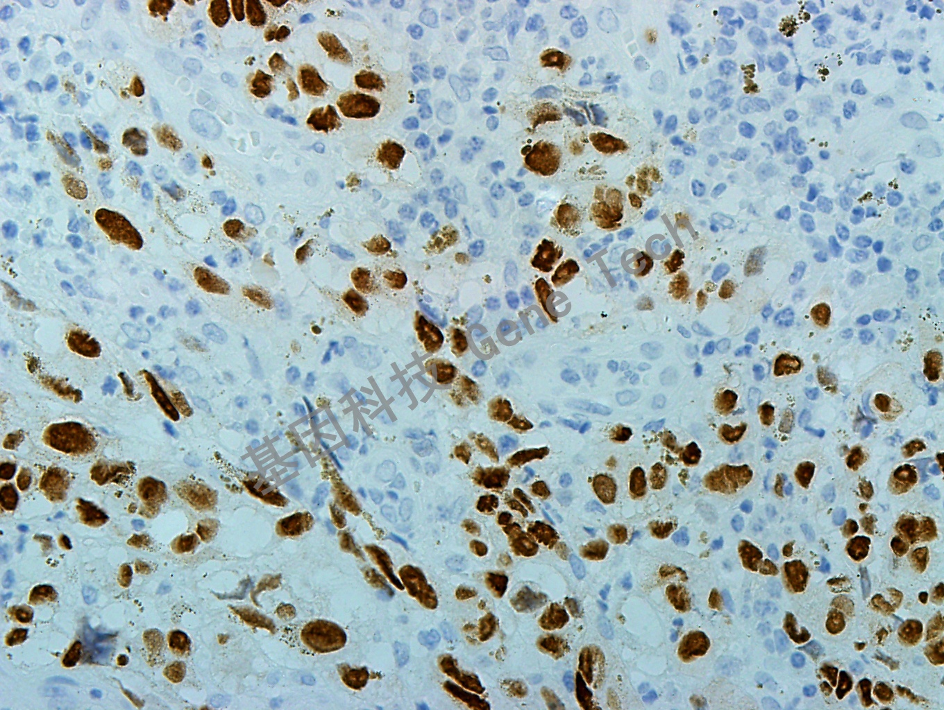 SOX10 GT2210 40X 黑色素瘤_副本.jpg