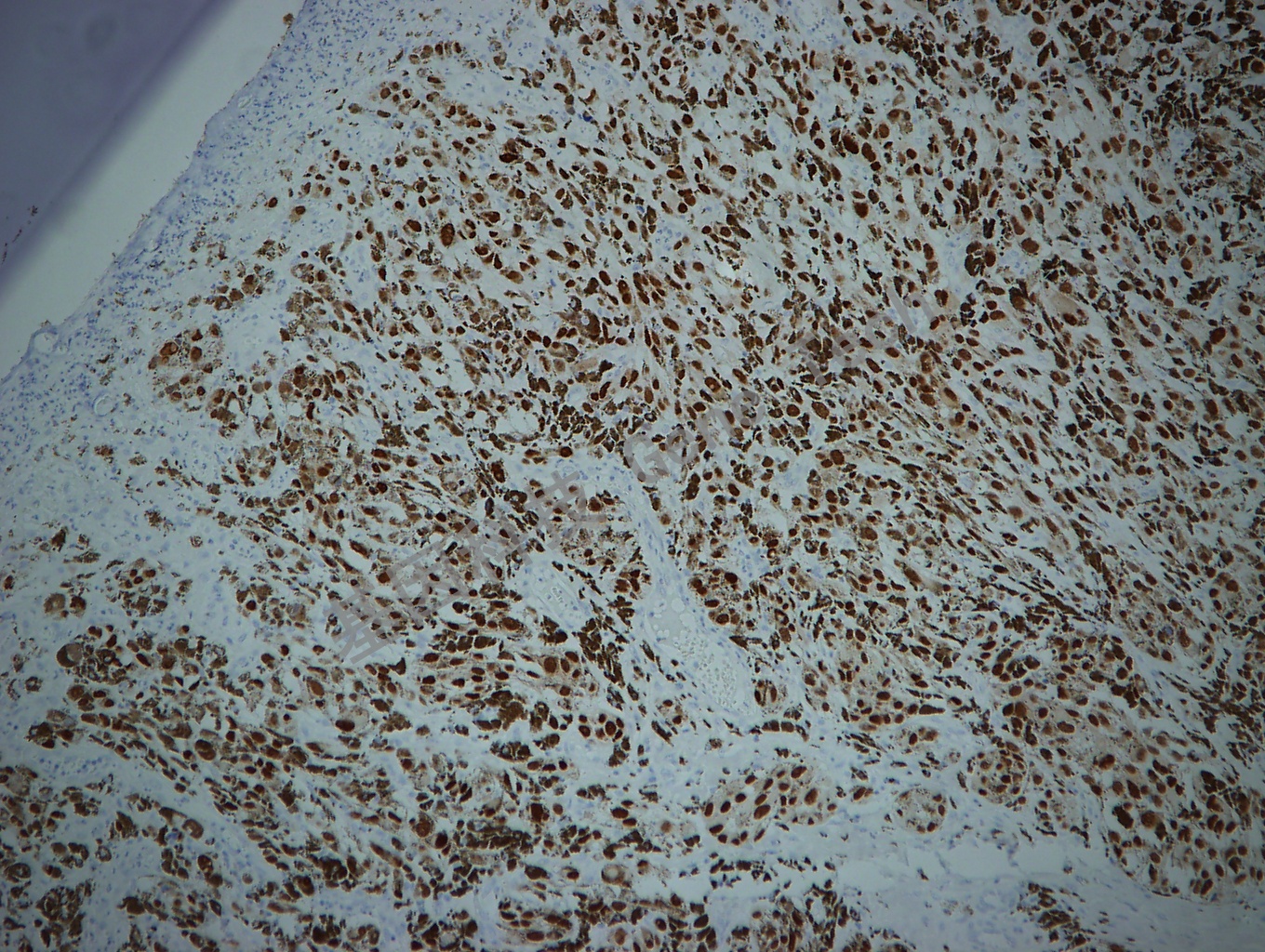 SOX10 GT2210 黑色素瘤10X_副本.jpg