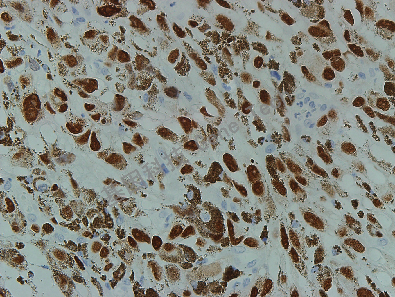 SOX10 GT2210 黑色素瘤40X_副本.jpg