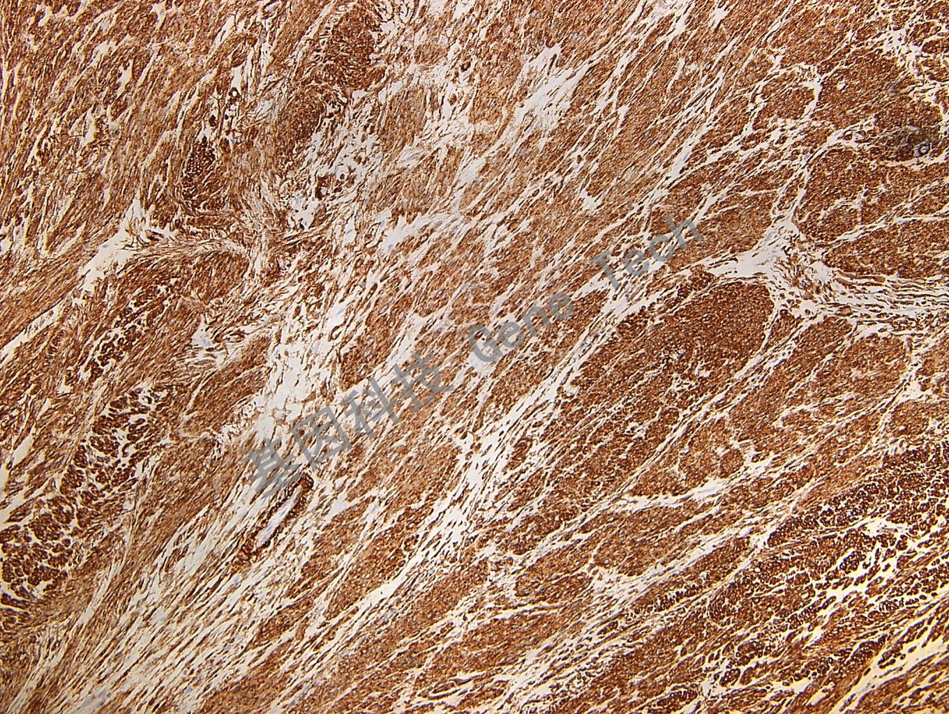 SMA GM0851 平滑肌瘤_副本.jpg