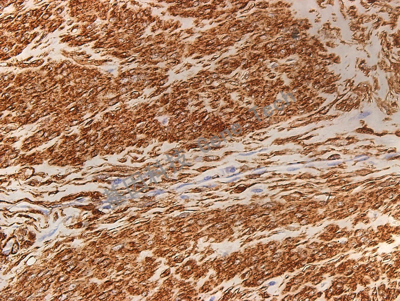 SMA GM0851 平滑肌瘤40_副本.jpg