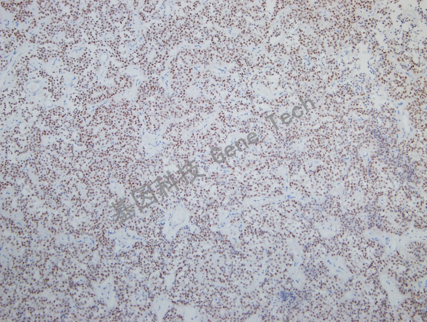 SF-1 垂体腺瘤-1_副本.jpg