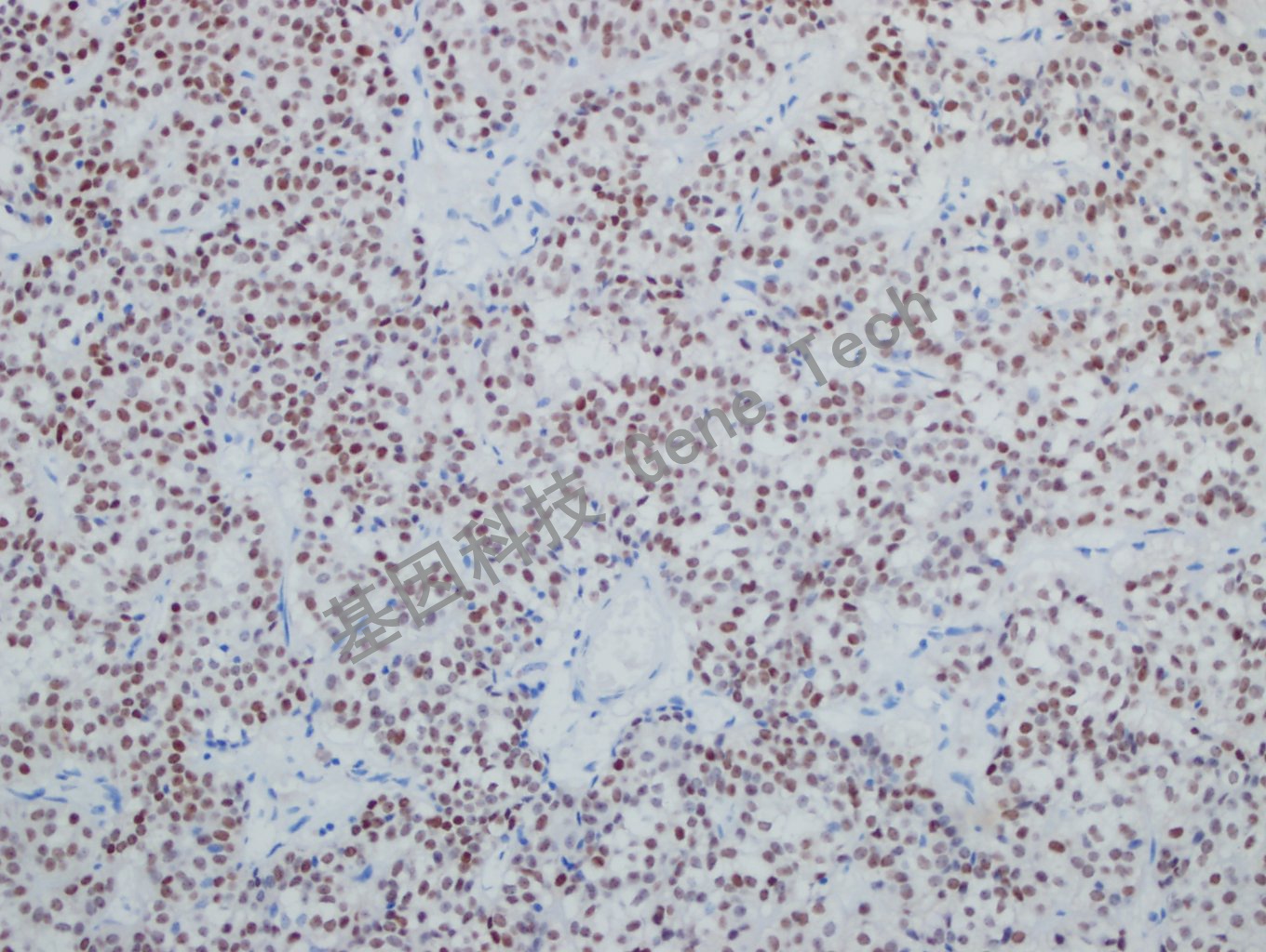 SF-1 垂体腺瘤-2_副本.jpg