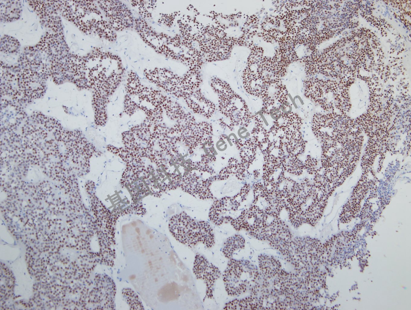 SF-1 垂体腺瘤-3_副本.jpg