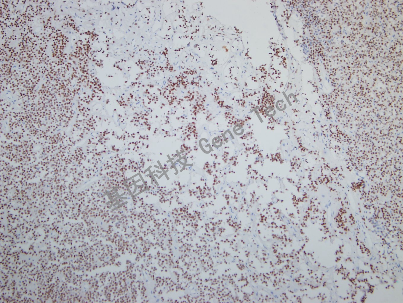 SF-1 垂体腺瘤-4_副本.jpg