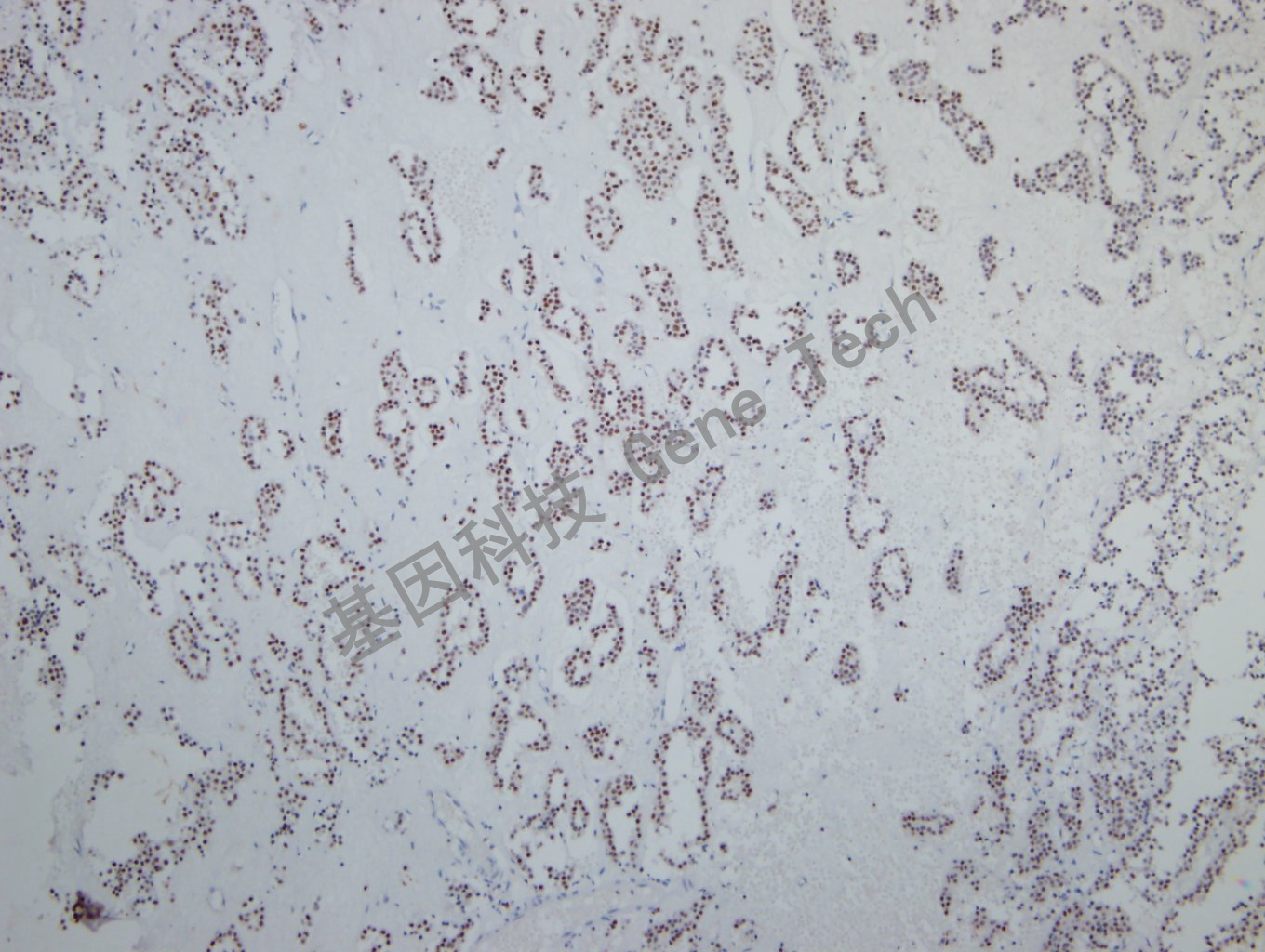 SF-1 垂体腺瘤-5_副本.jpg